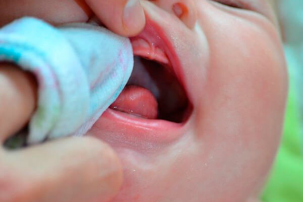 Молочница во рту у ребенка - чем лечить?