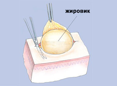 Почему появляются прыщи на голове в волосах?