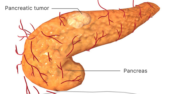 Рак головки поджелудочной железы - причины, симптомы, диагностика и лечение, прогноз