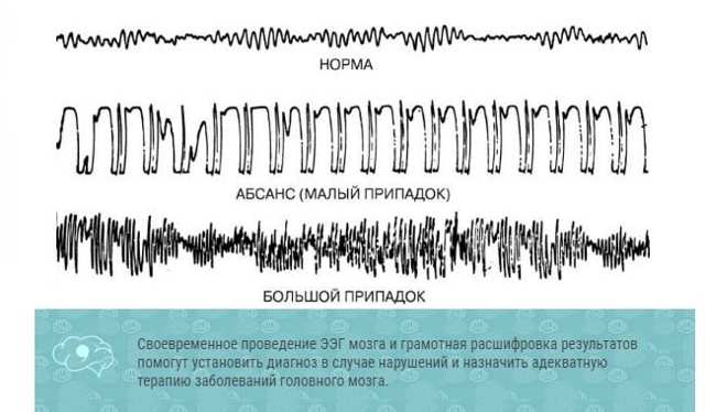 Расшифровка ЭЭГ у детей: норма и нарушения работы головного мозга