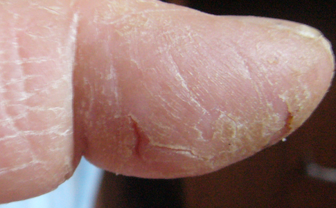 Трескается кожа на руках: сохнет и шелушится до крови, причины и лечение