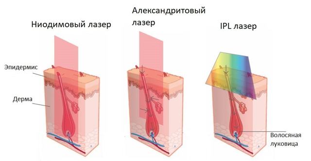 Виды лазеров, используемых в дерматологии и косметологии