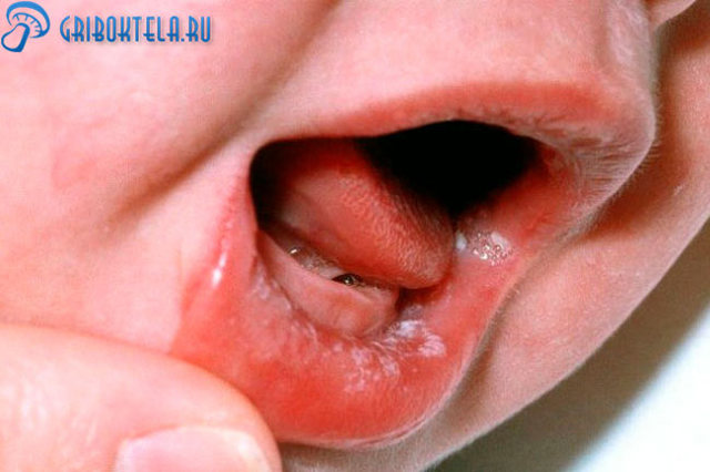 Молочница во рту у ребенка - чем лечить?