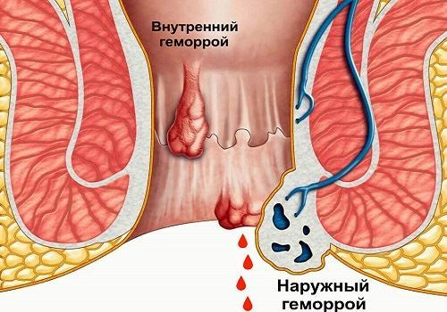 Свечи от геморроя, недорогие и эффективные при кровотечении: список лучших кровоостанавливающих суппозиториев, противовоспалительные геморроидальные средства