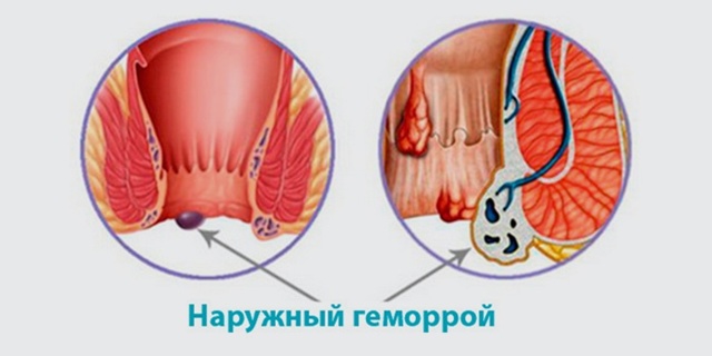 Внутренний и наружный геморрой: чем отличается лечение