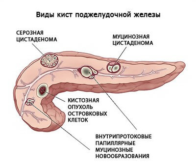 Как лечить поджелудочную железу: симптомы и советы врача, как питаться при панкреатите