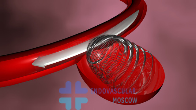 Эндоваскулярная хирургия аневризм артерий головного мозга – этапы проведения