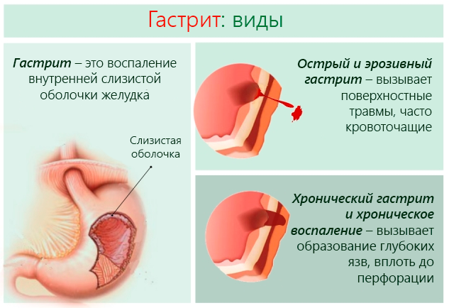 Список самых эффективных препаратов от гастрита: схема лечение медикаментами, что принимать при язве желудка