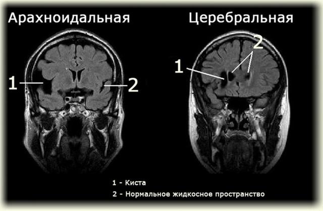 Киста у новорожденного в голове опасна ли? Причины и последствия