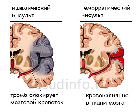 РЭГ (реоэнцефалография) сосудов головного мозга: что это такое?