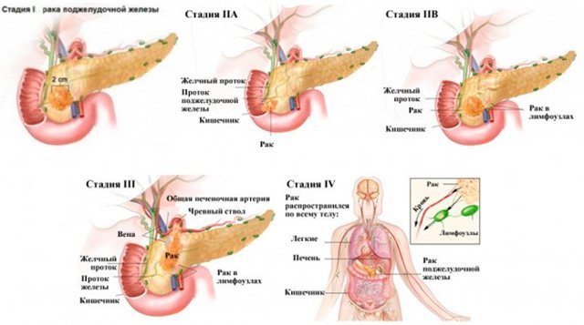 Рак поджелудочной железы - причины, симптомы, диагностика и лечение, прогноз