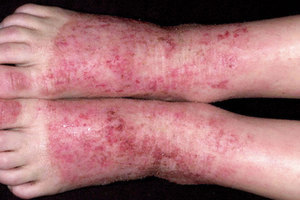 Лечение дерматита на ногах: фото, симптомы, причины, народные средства и профилактика