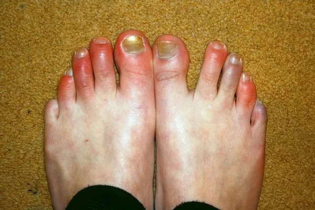 Волдыри на пальцах ног: причины и методы лечения