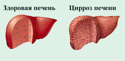 Бывает ли температура при заболевании печени