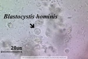 Blastocystis hominis в кале - что это означает, симптомы и лечение бластоцистоза у взрослых и детей