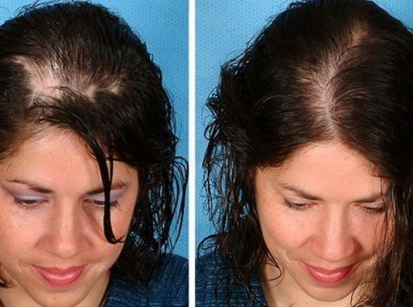 Мезотерапия для волос — метод стимуляции роста волос
