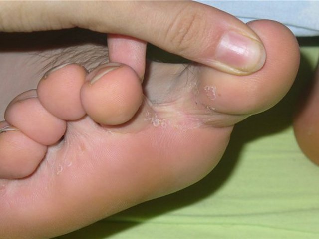 Покраснение между пальцев ног и зуд лечение