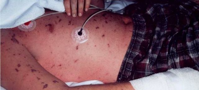 Признаки менингита у детей, сыпь при менингите (фото), как распознать менингит - симптомы у детей