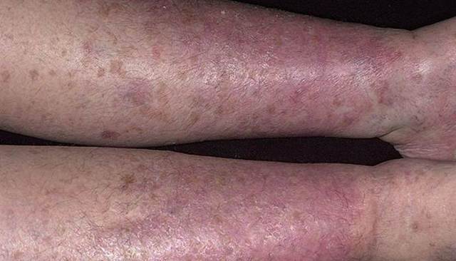 Дерматит на ногах (мокнущий, сухой, венозный) – причины, лечение