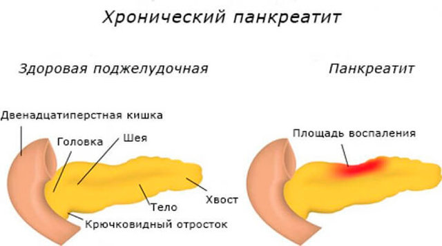 Тяжесть в желудке: что делать при появлении тяжести в животе и кишечнике, что принять при ощущении, что пища стоит, что делать, елси тянет желудок и понос