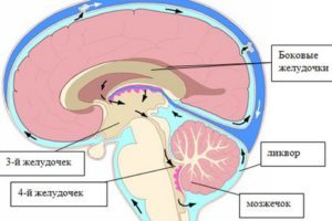 Внутренняя гипертензия головного мозга