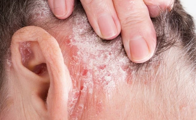 Псориаз на лице - как проявляется и чем его лечить?