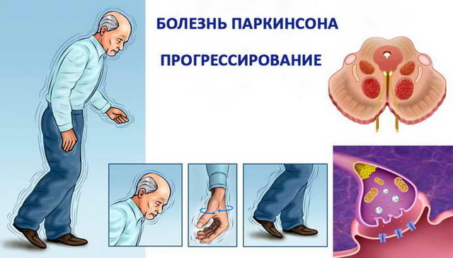 Общее и отличия Паркинсонизма и болезни Паркинсона