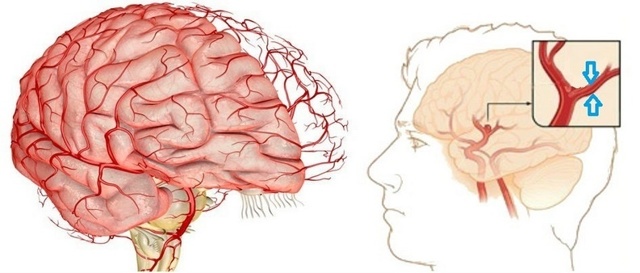 Спазм сосудов головного мозга: симптомы и лечение (препараты, таблетки)