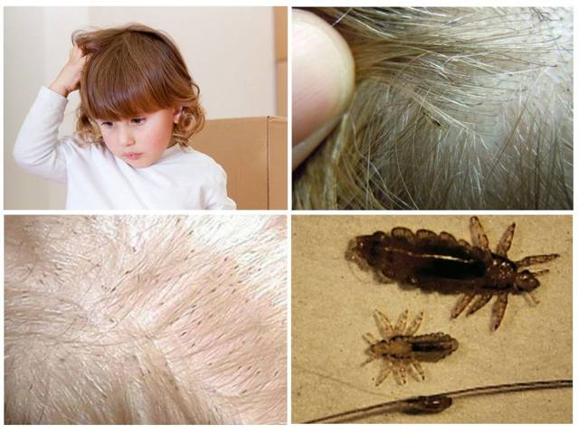 Вши у ребенка на голове: фото, внешний вид и описание симптомов