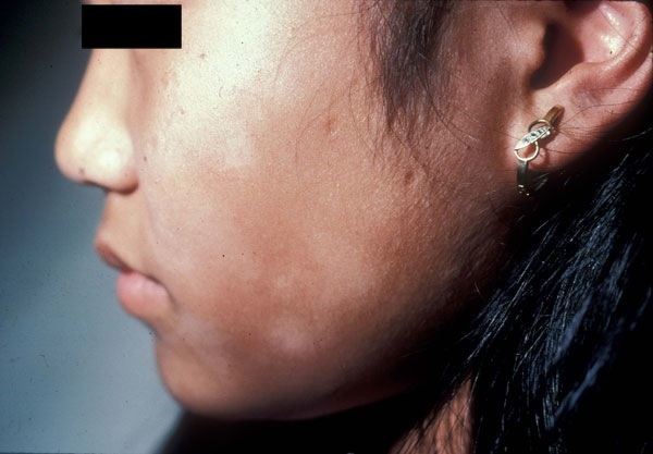 Появились белые пятна на лице у ребенка и на коже: причины и фото
