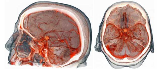 Как проверить сосуды головного мозга: диагностика, методы