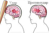 Ушиб головного мозга: причины, симптомы, степени, лечение