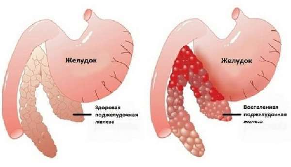 Что помогает от вздутия живота: лекарства, таблетки, препараты