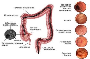 Колоноскопия – отзывы, или как я делал колоноскопию