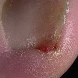 Болит и гноится большой палец на ноге у ногтя: что делать и как лечить