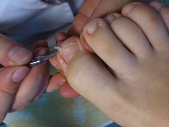 Нарывает палец на ноге возле ногтя: лечение и профилактика