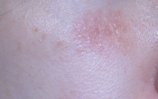 Маленькие красные шелушащиеся сухие пятна на теле: причины появления