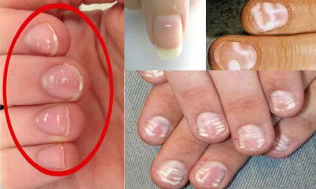Белые пятна на ногтях пальцев рук, причина и лечение