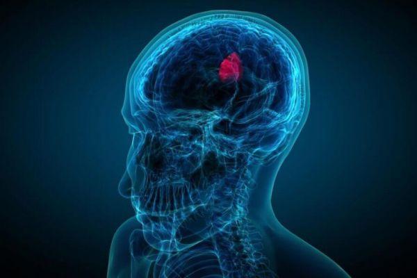 Ретроцеребеллярная арахноидальная киста головного мозга: размеры и лечение