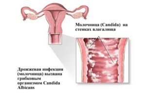 Выделения при беременности на ранних сроках: 2-5, 6-8, 9-12 неделях темные выделения