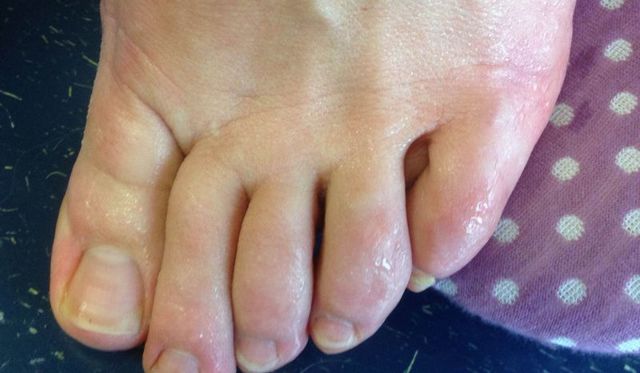 Почему шелушится и облазит кожа между пальцами ног