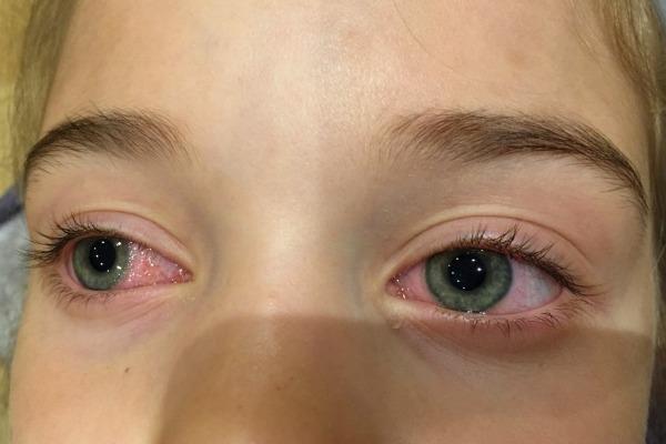 Частое моргание глазами у взрослых: причины, лечение