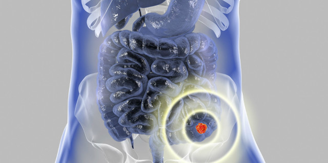 Метастазы рака прямой кишки