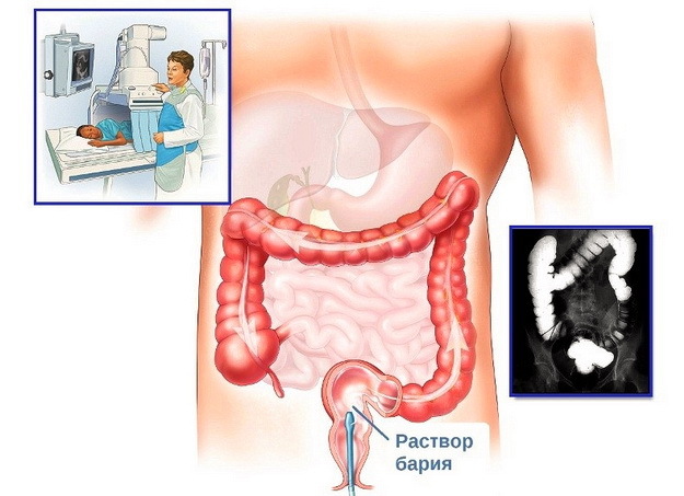 Ирригоскопия кишечника: подготовка пациента к обследованию
