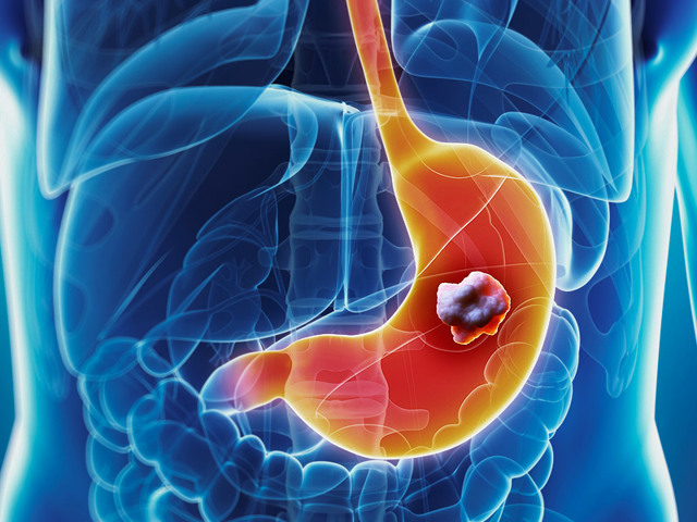 Рак желудка – причины, признаки, симптомы и лечение рака желудка 4 стадии. Операция и химиотерапия