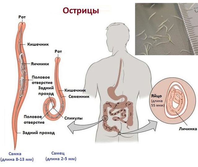 Энтеробиоз (острицы) что это: симптомы и лечение у взрослых