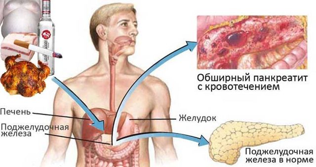 Почему после употребления алкоголя появляется понос: причины появления диареи после спиртного и методы терапии, первая помощь и профилактика состояния