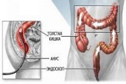 Заболевание кишечника: признаки, диета, и диагностика болезни