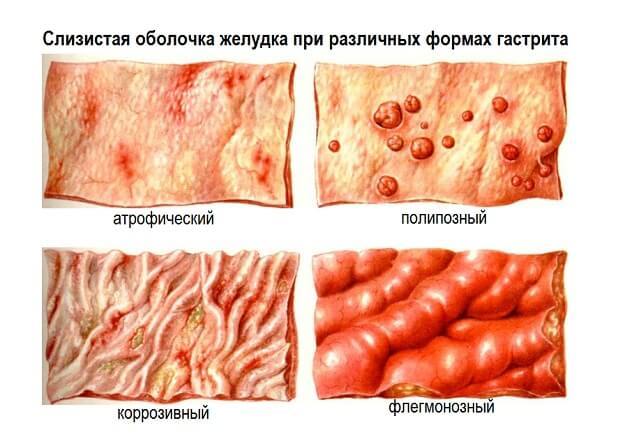 Режущая боль в желудке: что делать при резях, причины и лечение заболеваний