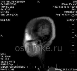 Что показывает МРТ головного мозга